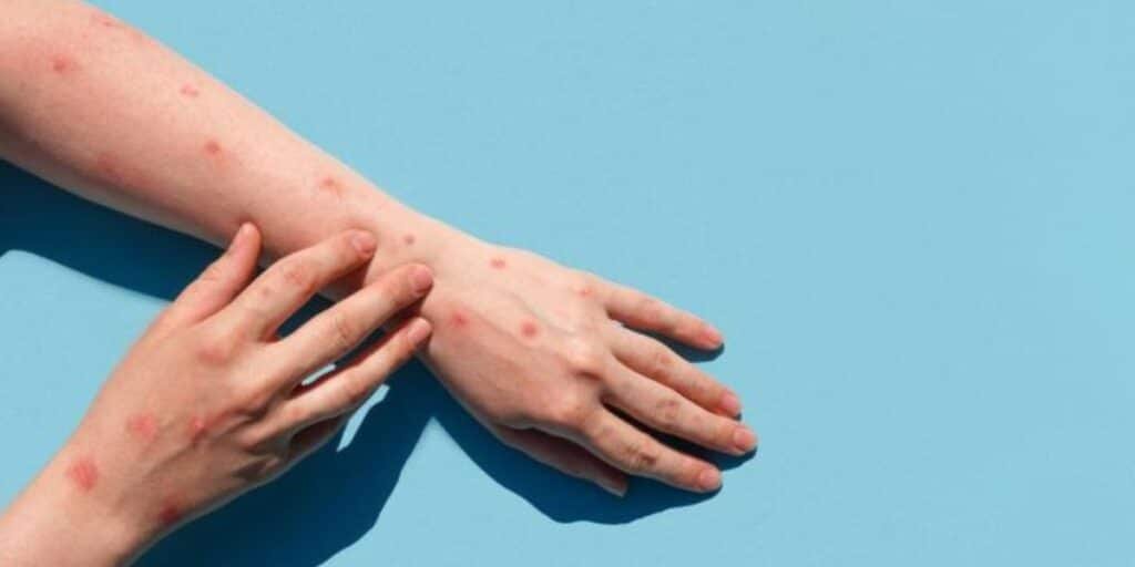 First Monkeypox case reported in Karachi