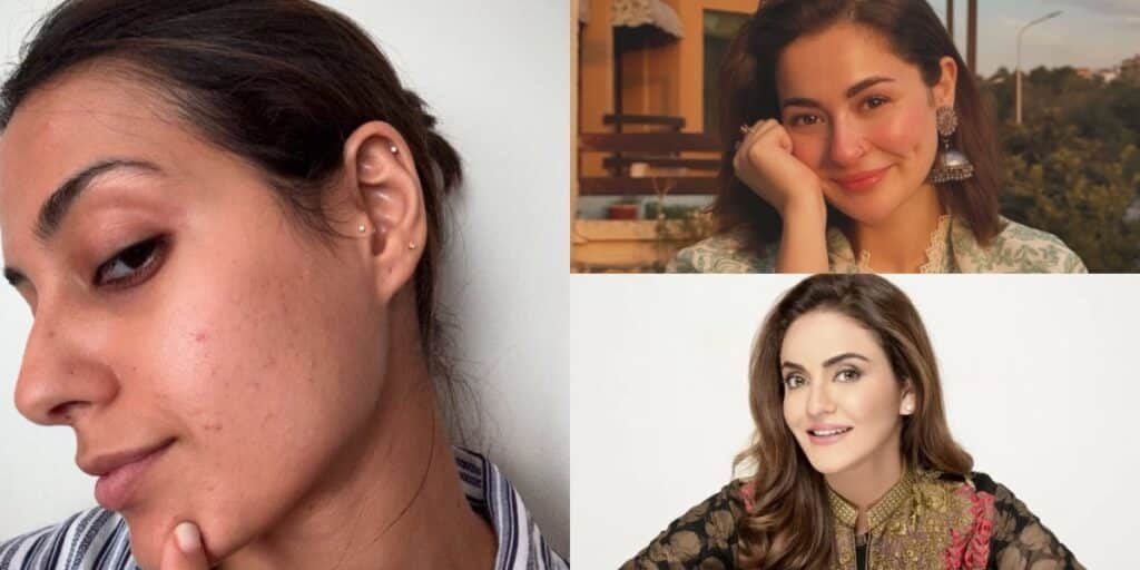 Fellow celebs praise Iqra Aziz for opening up about skin problems