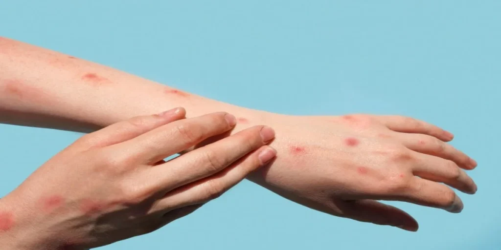 Chikungunya