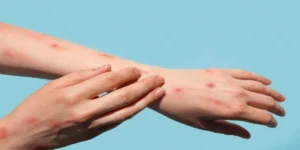 Chikungunya